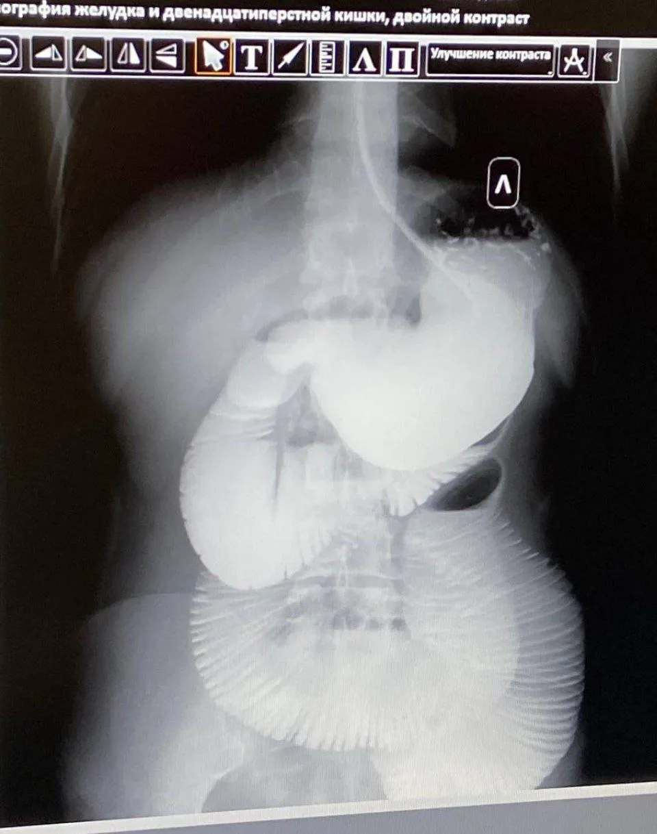 Скрытая угроза: хирургическая помощь при онкозаболеваниях.